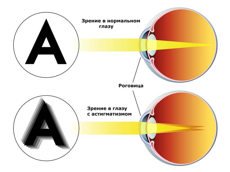 Берут ли в армию с астигматизмом?